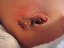umbilical-cord-stump-newborn-baby-girl