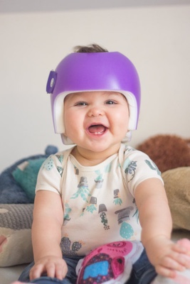 plagiocephaly helmet cost