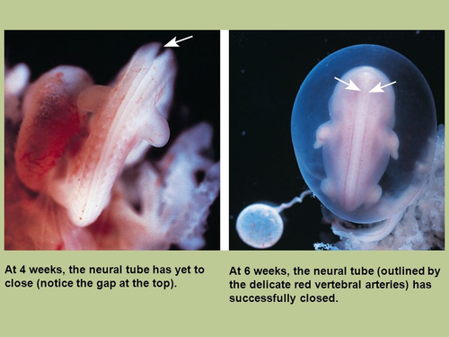 prenatal multivitamins - neural tube