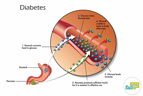 gestational diabetes
