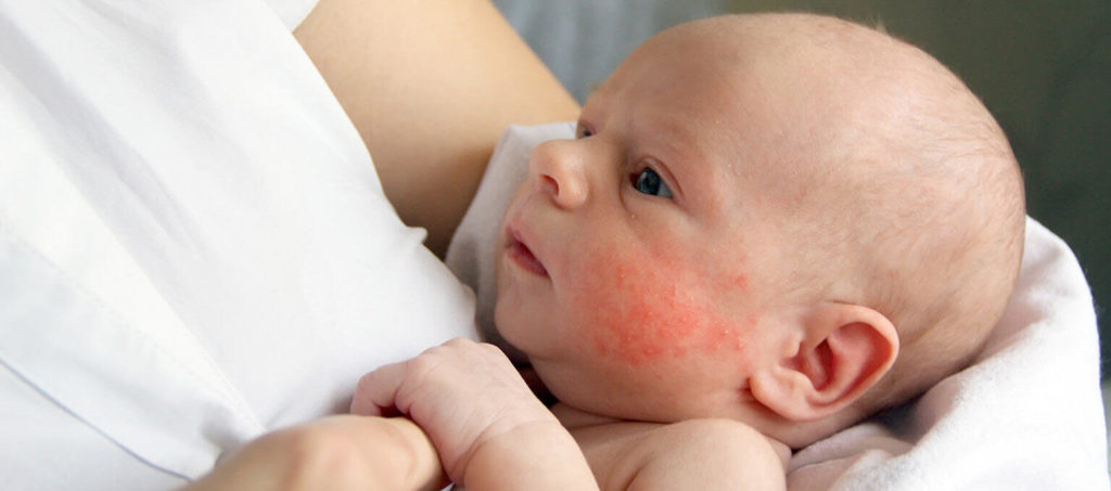 preventing food allergies -- eczema risk factor