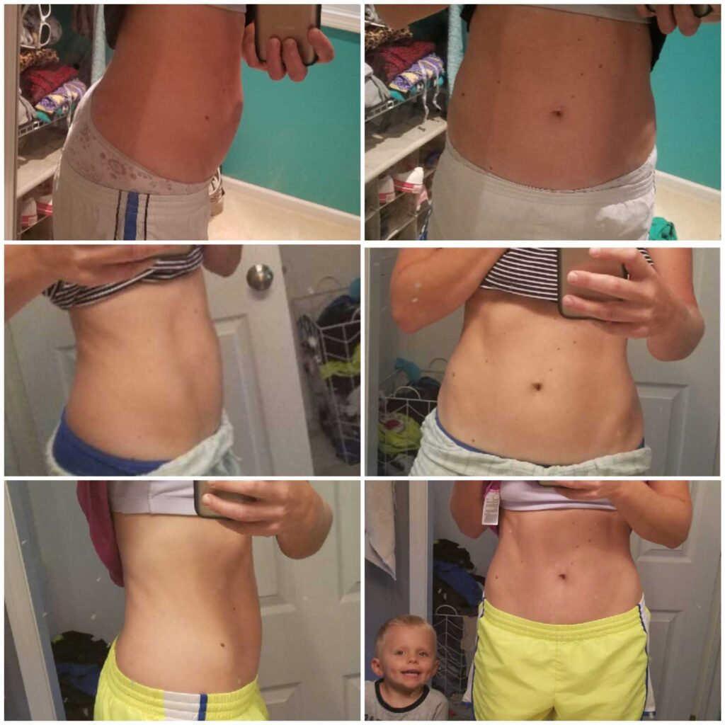 Before and After Diastasis Recti Pictures