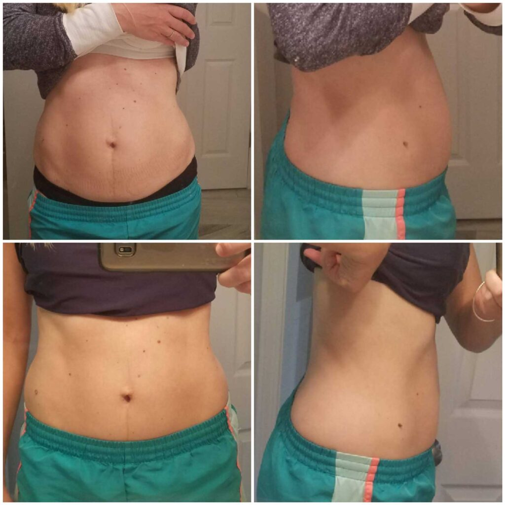 Diastasis Recti After and Before 