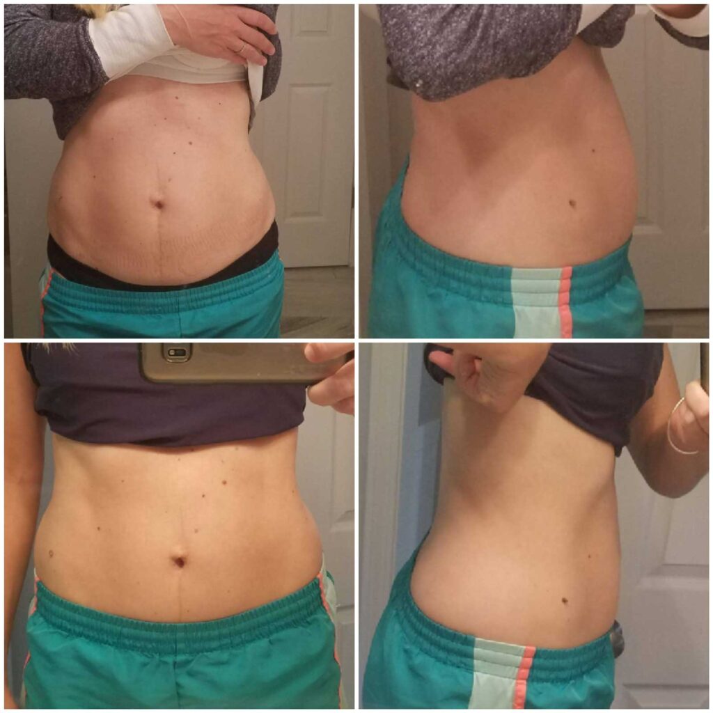 Diastasis Recti Before And After [Without Surgery]  Lucies List