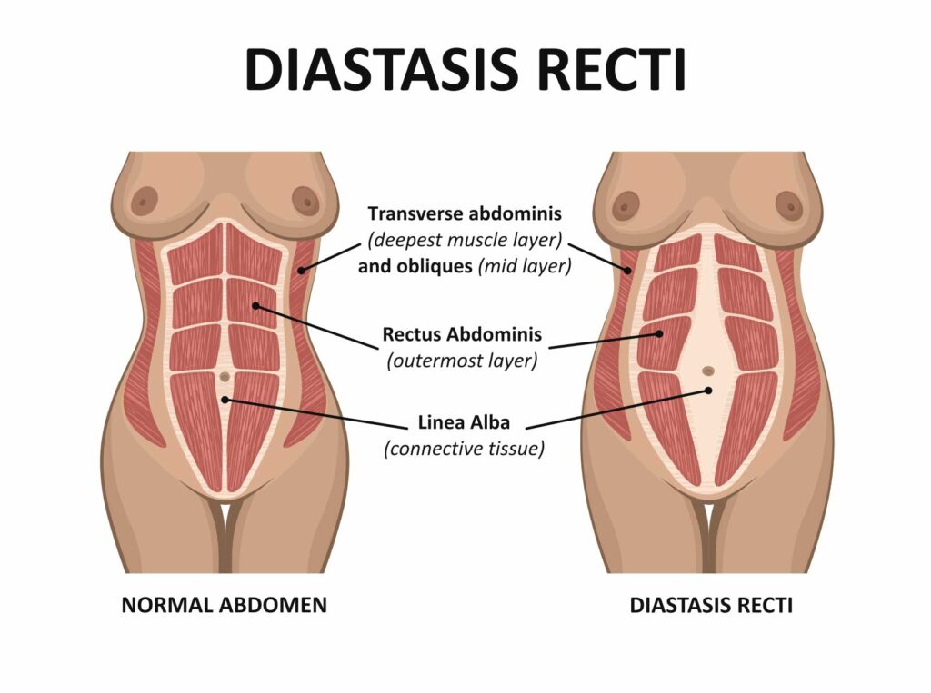 Diastasis Recti Before and After