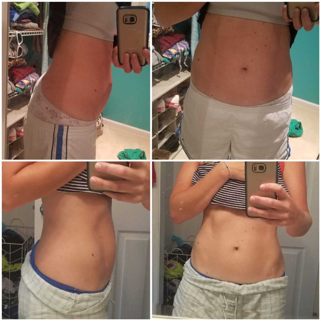 Diastasis Recti Before And After