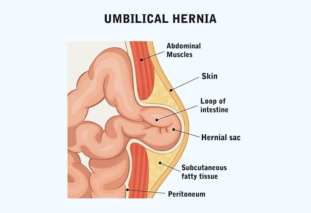 umbilical hernia anatomy